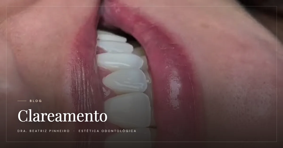 Clareamento dental: mitos e verdades que você precisa conhecer
