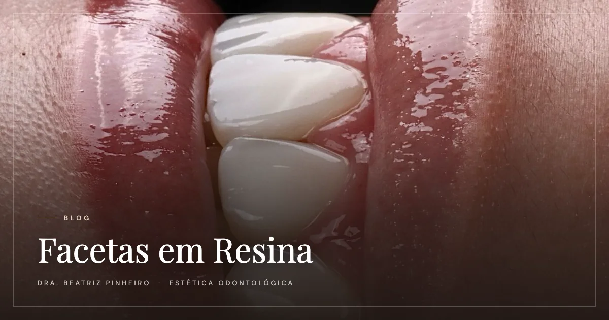 Facetas em resina: tudo o que você precisa saber antes de fazer