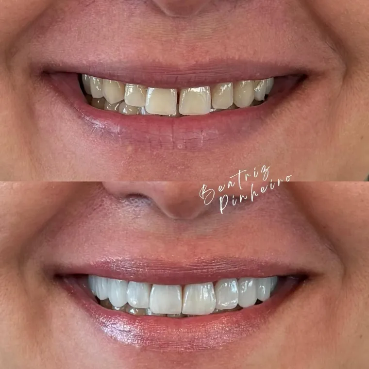 Comparação do sorriso de uma paciente antes e depois das facetas