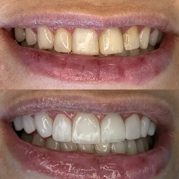 Sorriso de uma paciente antes e depois do tratamento estético