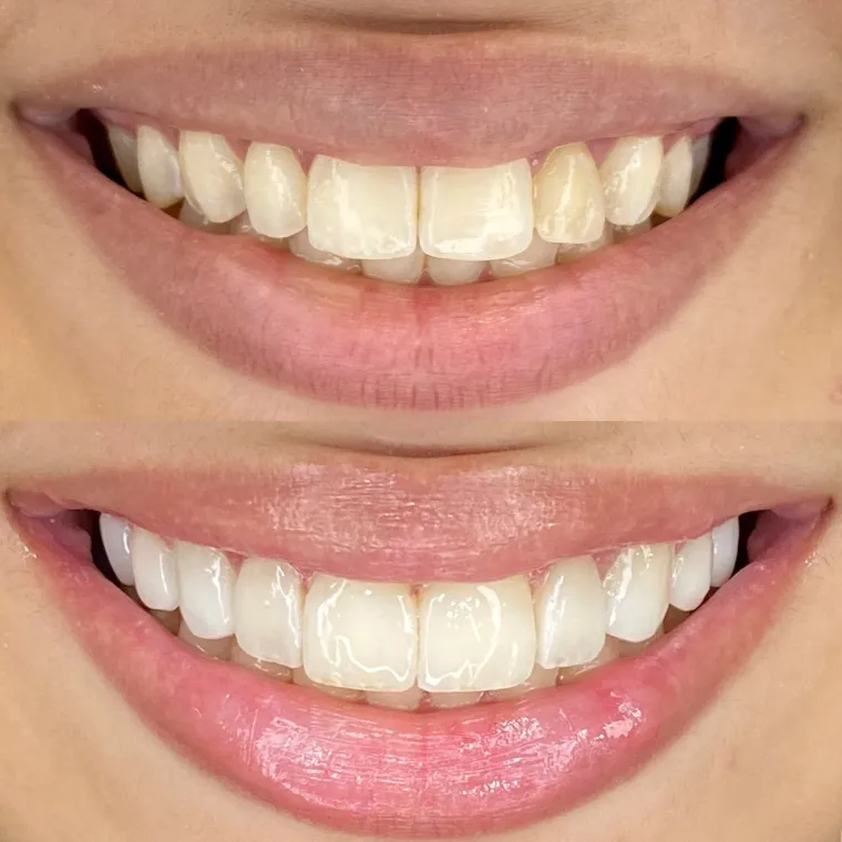 Sorriso de uma paciente antes e depois do clareamento e das facetas
