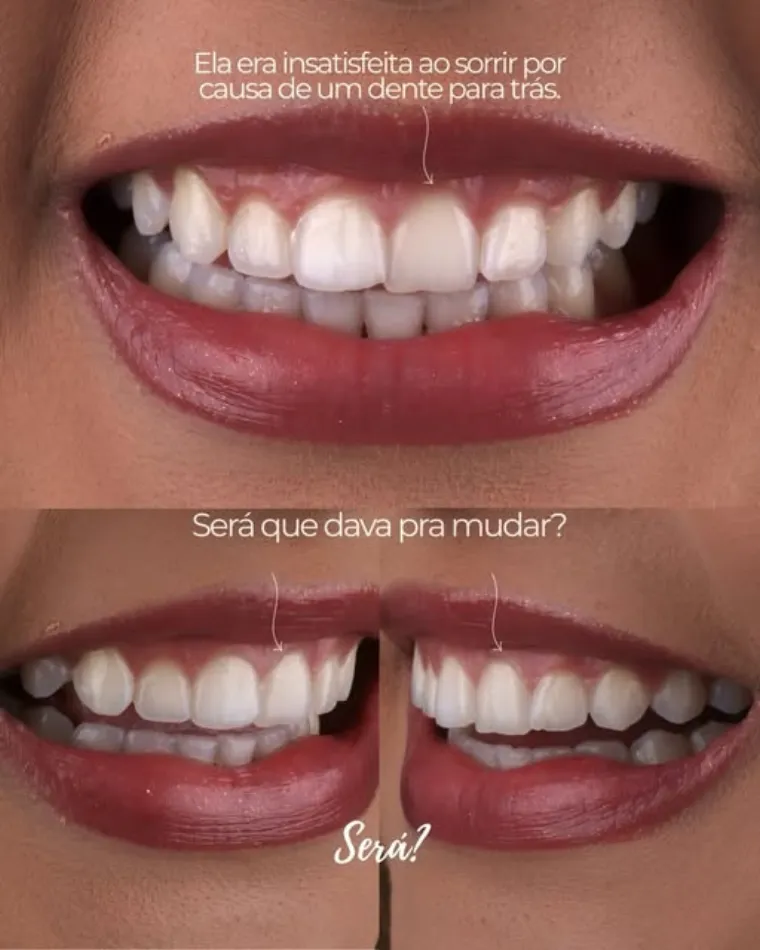 Sorriso de uma paciente antes e depois do tratamento, com o dente alinhado