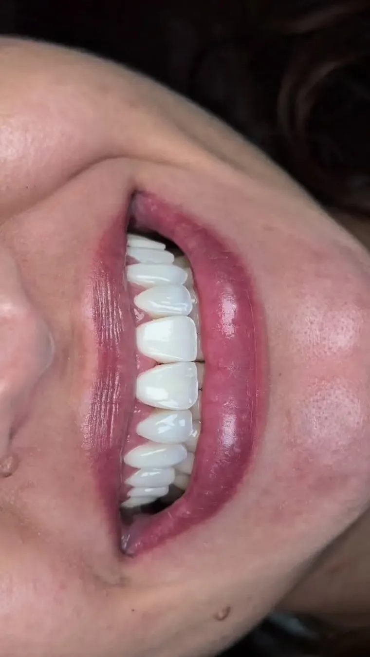 Detalhe lateral do sorriso finalizado de uma paciente
