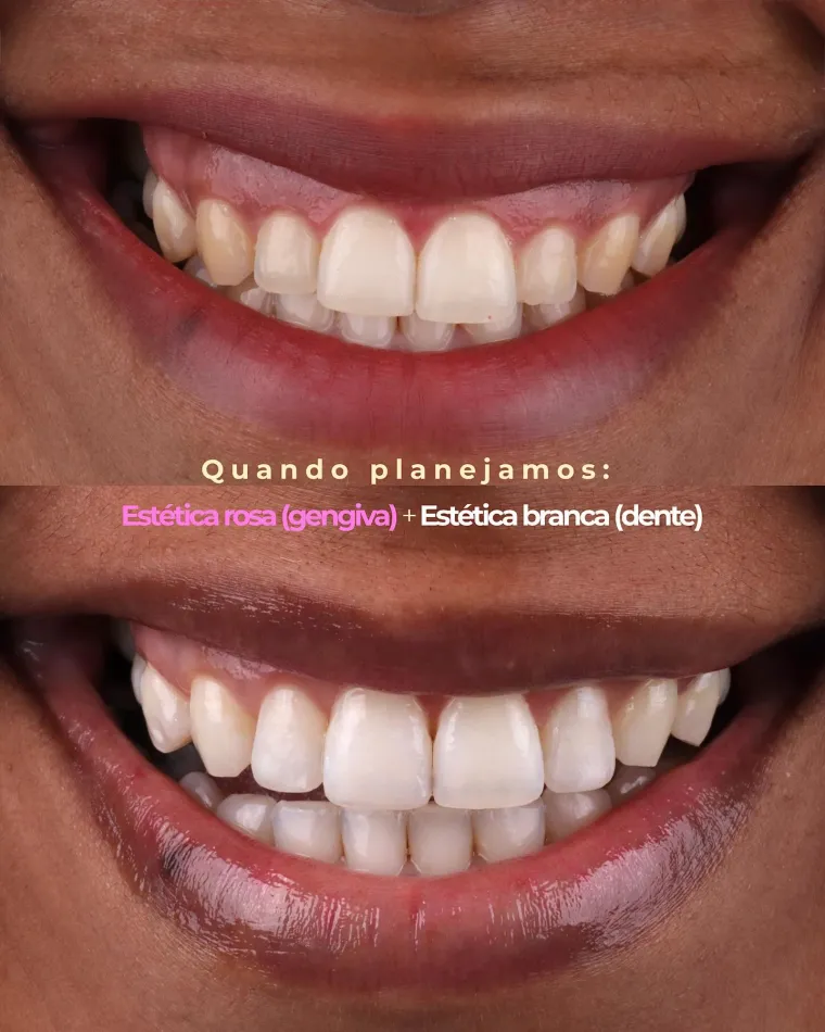 Sorriso antes e depois do tratamento de gengiva e dentes