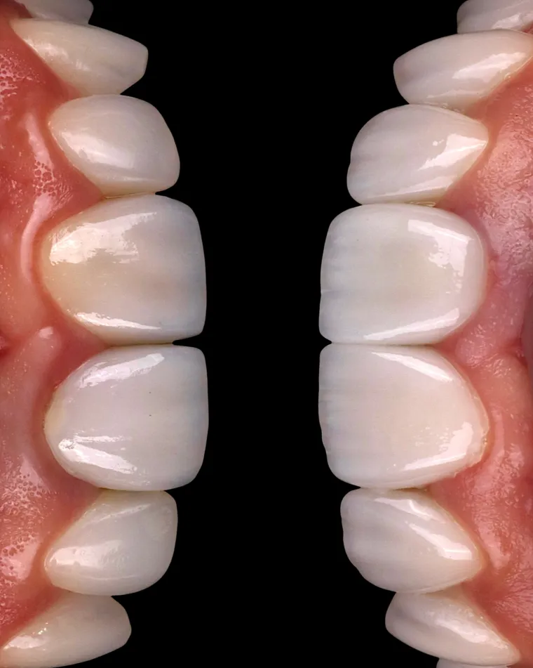 Detalhe aproximado de facetas em resina, com o dente ampliado