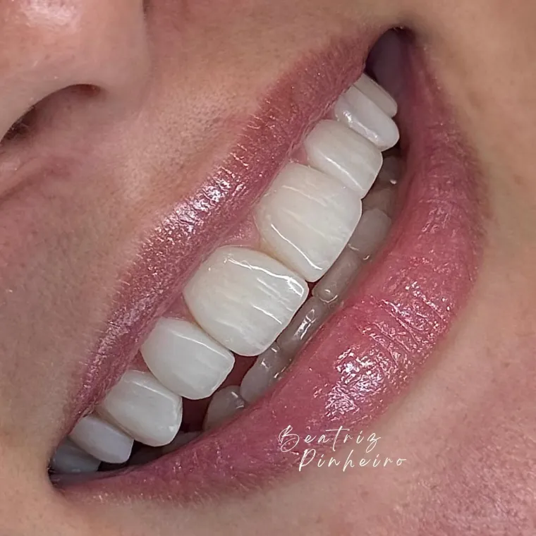 Sorriso de perfil, com o acabamento das facetas em resina