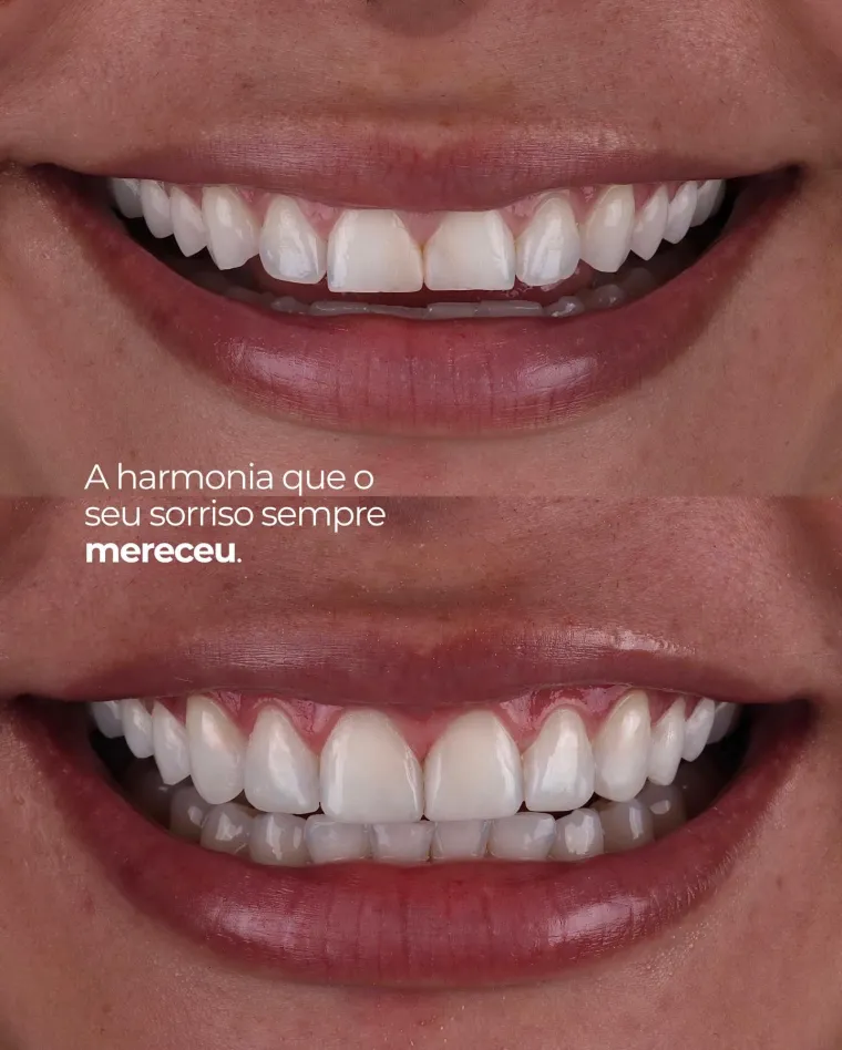 Sorriso antes e depois, com os dentes proporcionais entre si