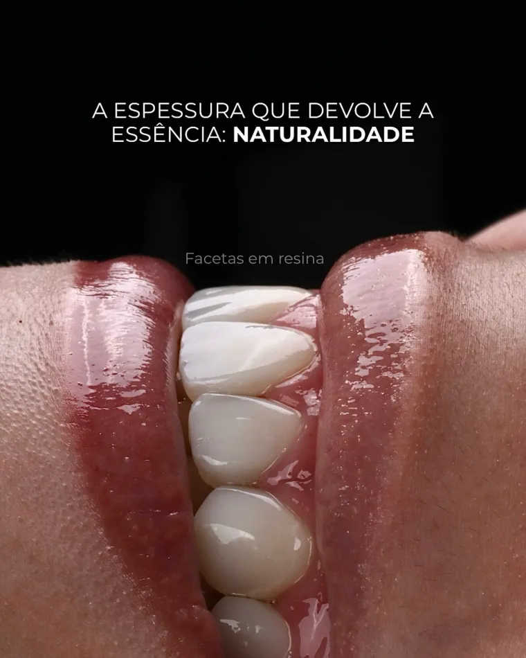 Detalhe da espessura e da translucidez das facetas em resina