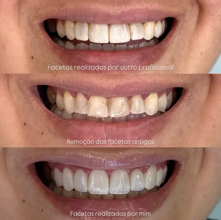 Etapas da troca de facetas antigas por facetas novas em resina