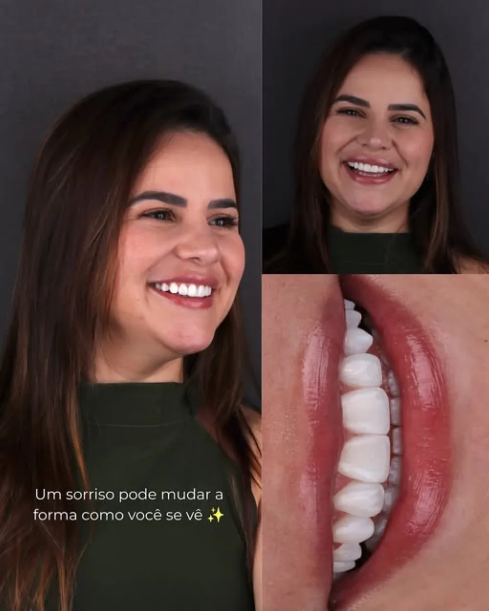 Paciente sorrindo após tratamento estético, com detalhe do sorriso