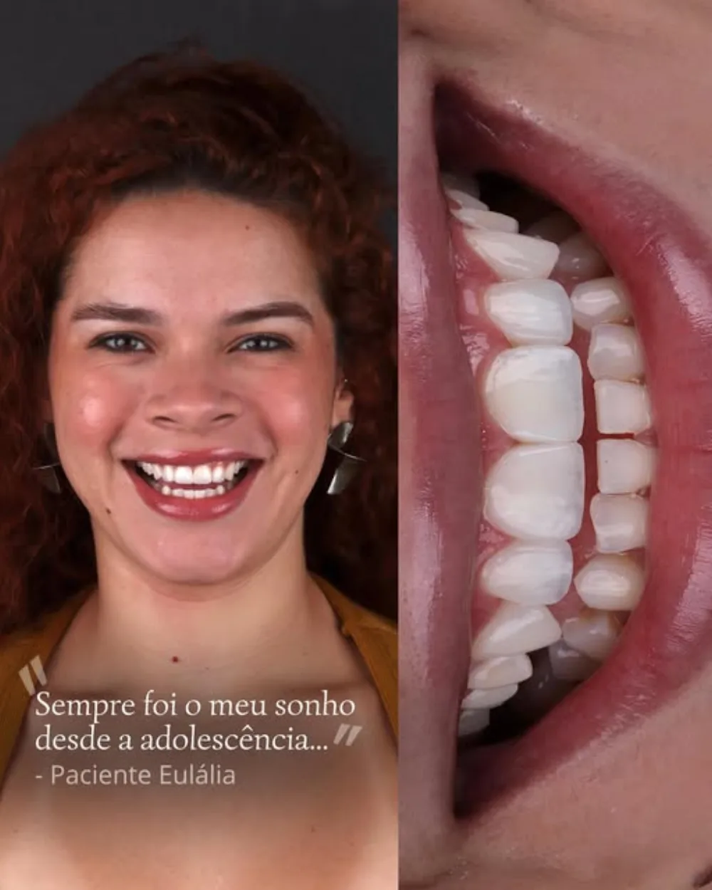 Paciente sorrindo após tratamento estético, com detalhe do resultado natural